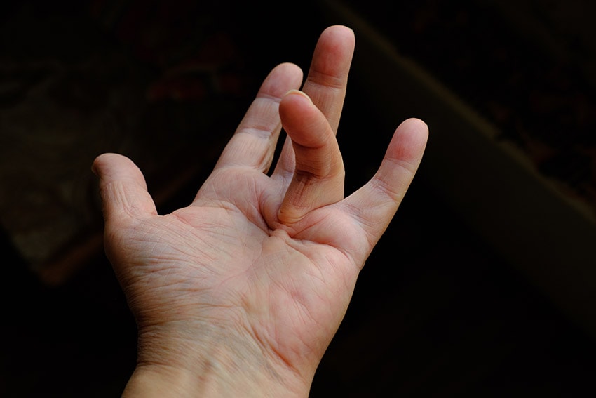 Dupuytren's disease
