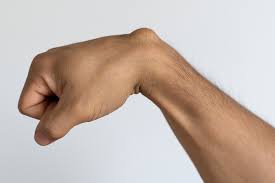 Wrist ganglion cyst