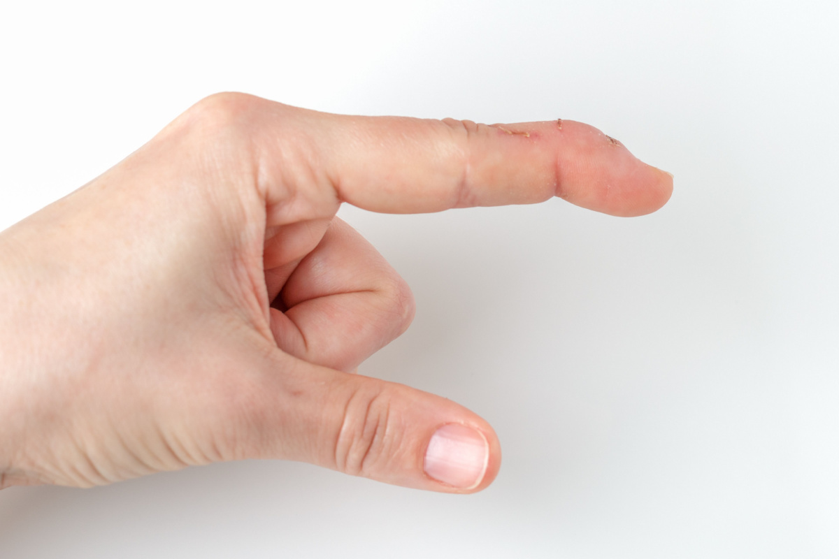 Mallet finger