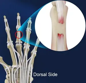 Tendon injury