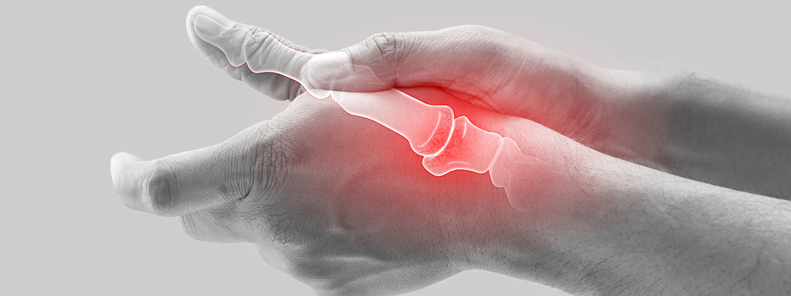 Thumb CMC arthritis