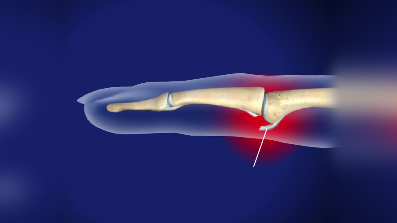 Volar plate injury