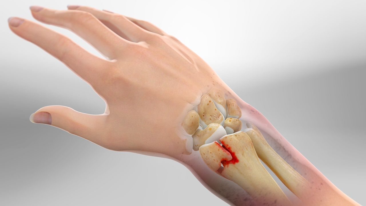 Wrist fractures